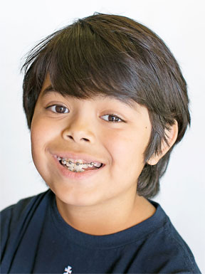 does_your_child_need_braces