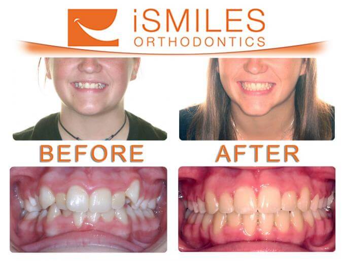 Irvine Orthodontist Patient 1
