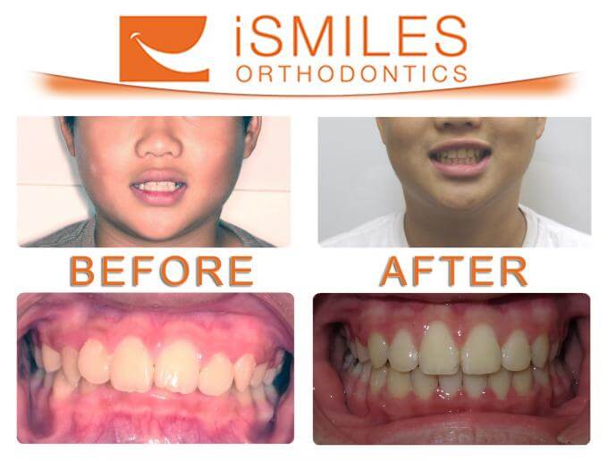 Irvine Orthodontist Patient 2