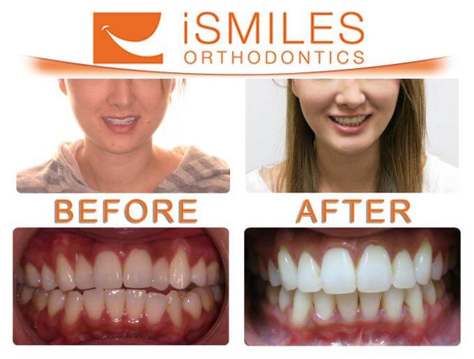 Irvine Orthodontist Patient 3