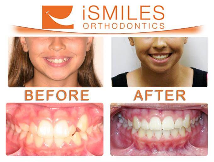 Irvine Orthodontist Patient 4