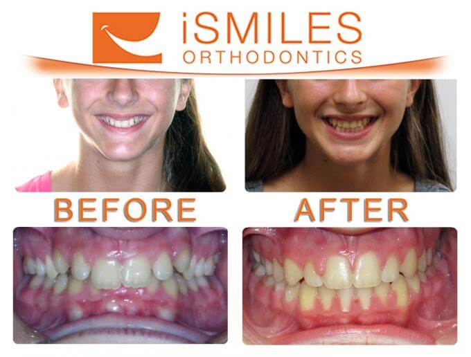 Irvine Orthodontist Patient 5