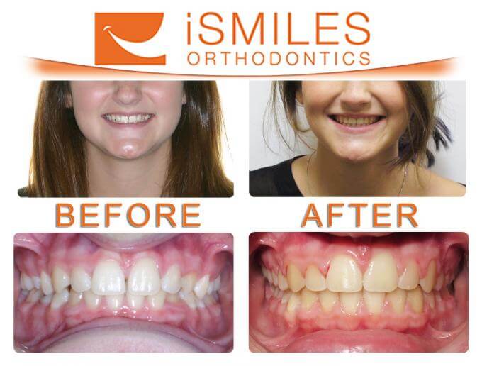 iSmiles Orthodontics Patient 1