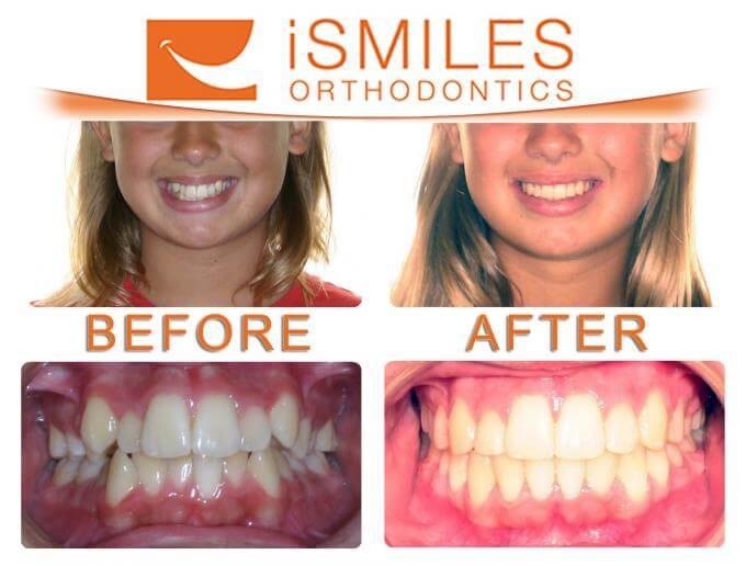 iSmiles Orthodontics Patient 2