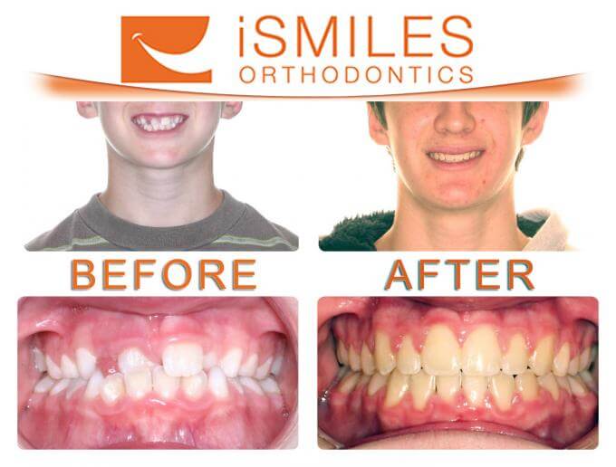 iSmiles Orthodontics Patient 3