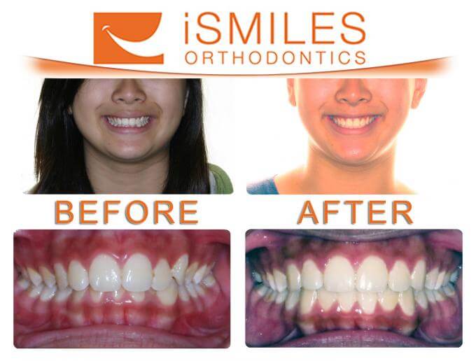 iSmiles Orthodontics Patient 4