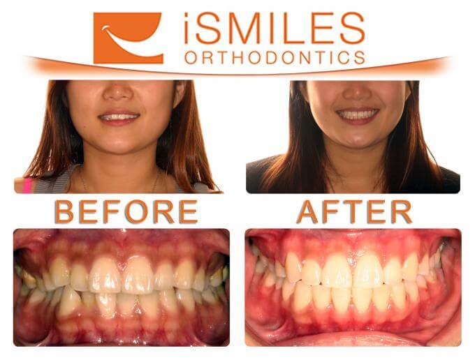iSmiles Orthodontics Patient 5