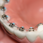 Lingual Braces