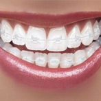 Traditional Braces in Irvine, CA