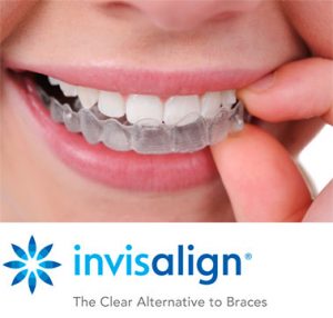 invisalign in irvine