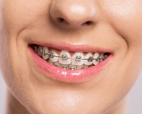 traditional braces in irvine