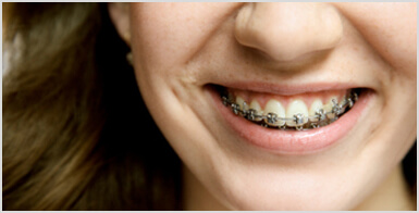 traditional fixed braces