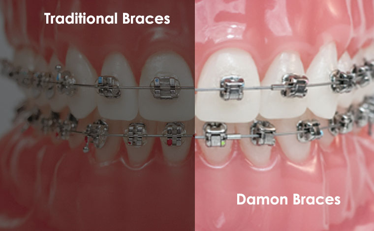 whats the difference between damon braces and traditional braces